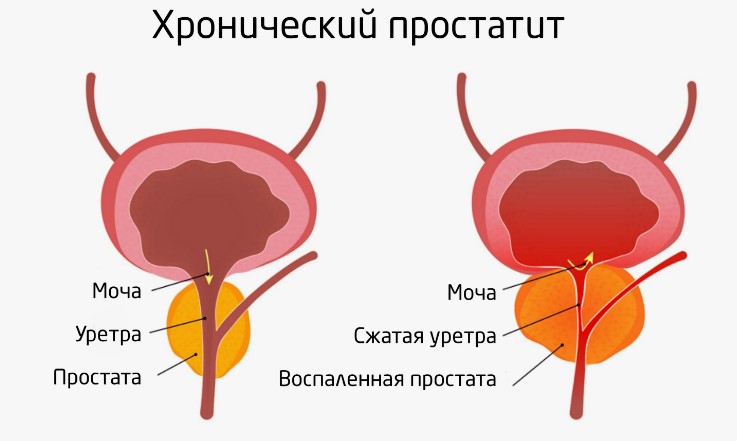 Профилактика и лечение заболеваний простаты